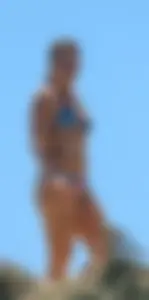 Sexy girl with skin condition in blue bikini