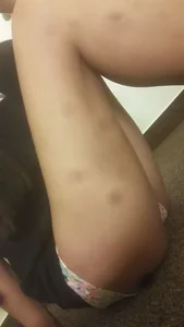 Bruised Legs in Panties Closeup Home Selfie - Girl Sitting on the Floor