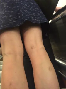 Hot Redhead in a Dress with Bruisers on Her Legs Hot Subway Creepshots