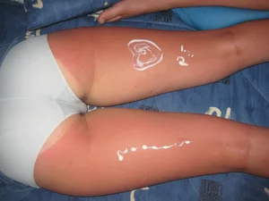 Sunburned Female Candid Legs With Very Red Skin And Some Soothing Cream Squeezed in Them, Closeup Creepshot